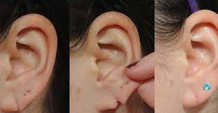 Why earlobe surgery is important