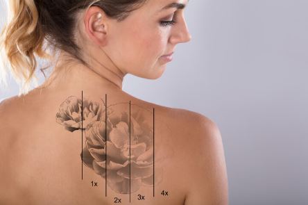 What could be expected from laser tattoo removal